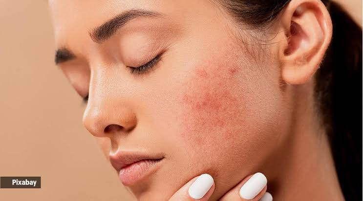Why do we get pimples?