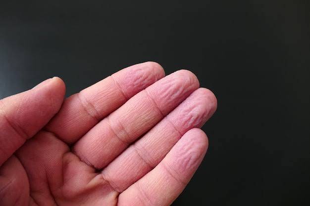 Why do our fingers wrinkle in water?